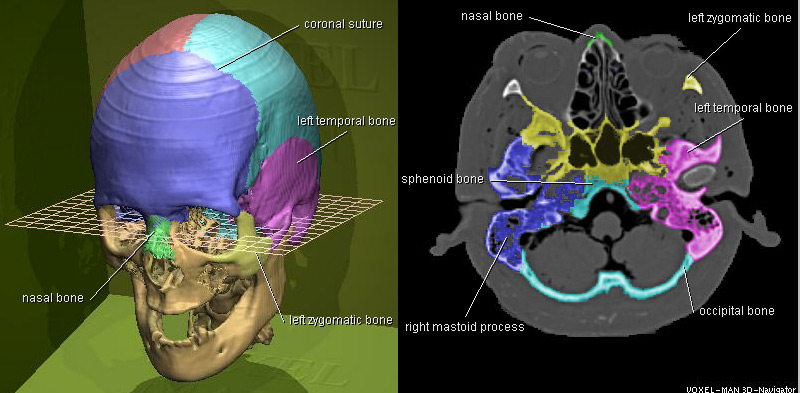 Voxel-Man 3D-Navigator: Brain and Skull