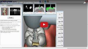 cavity preparation