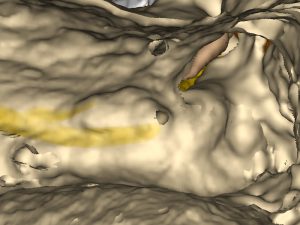 Course of facial nerve and chorda tympani in the bone.