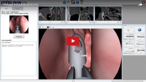 virtual infundibulotomy