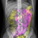 X-ray image of the torso, with colored small intestine (purple) and large intestine (yellow)