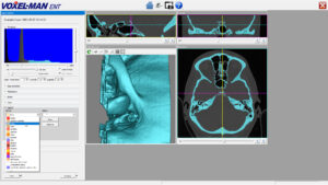 Definition of a 3D model from CT for bone drilling in VOXEL-MAN My Cases