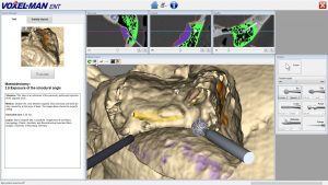 Virtual mastoidectomy with VOXEL-MAN Tempo